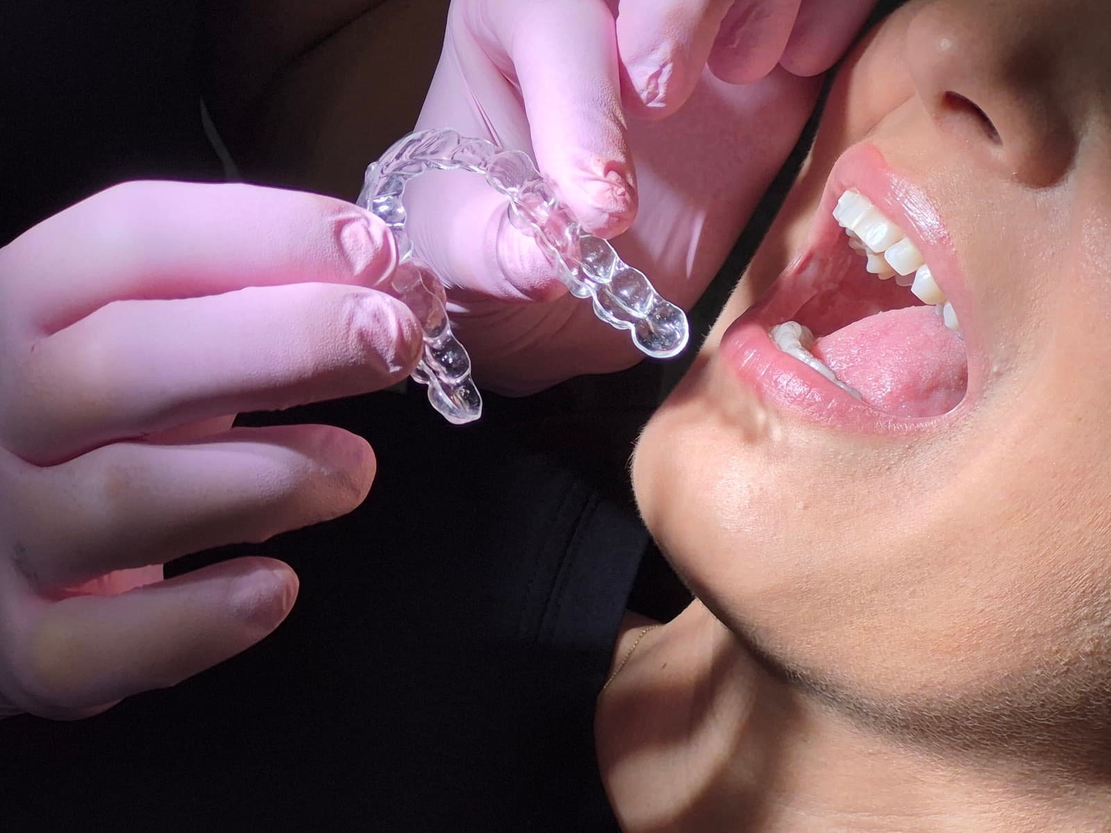 Hands in pink gloves hold a clear Spark aligner next to a patient's open mouth, before fitting it over the teeth